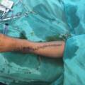 Horizontal Loop Mattress Suture: A Technique That Every Surgeon Should Know