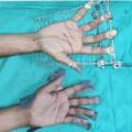 Jain’s hand retractor system and stand: an innovative device for hand surgery